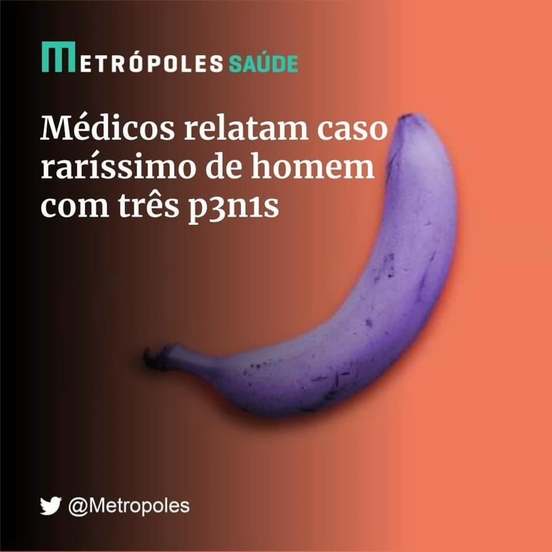Um caso de trifalia, condição congênita extremamente rara caracterizada pela presença